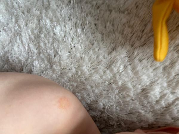 Bild zu Flecken - Baby Forum - Allgemeine Themen