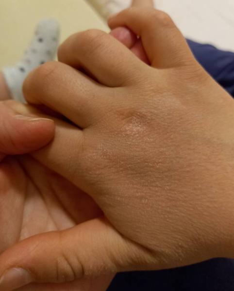 Bild zu Ist das Neurodermitis? - Baby Forum - Allgemeine Themen