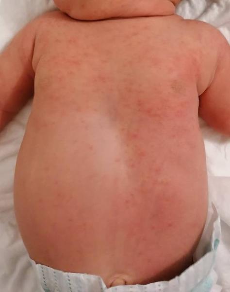 Bild zu Babyakne? - Baby Forum - Allgemeine Themen