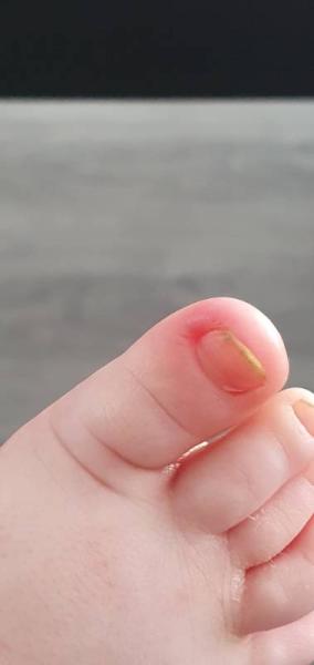 Bild zu Nagelbettentzündung - Baby Forum - Allgemeine Themen