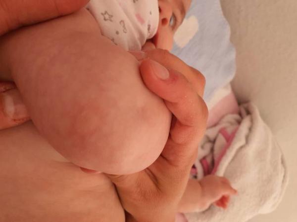 Bild zu Roter Fleck - Baby Forum - Allgemeine Themen
