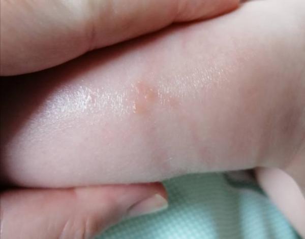 Bild zu Ausschlag am Bein - Baby Forum - Allgemeine Themen