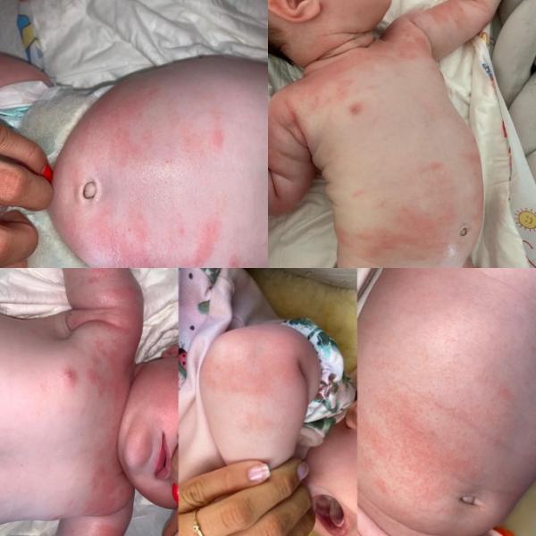 Bild zu Neurodermitis? Hilfe?!:( - Baby Forum - Allgemeine Themen