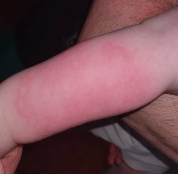 Bild zu Was ist das für ein Ausschlag?? - Baby Forum - Allgemeine Themen