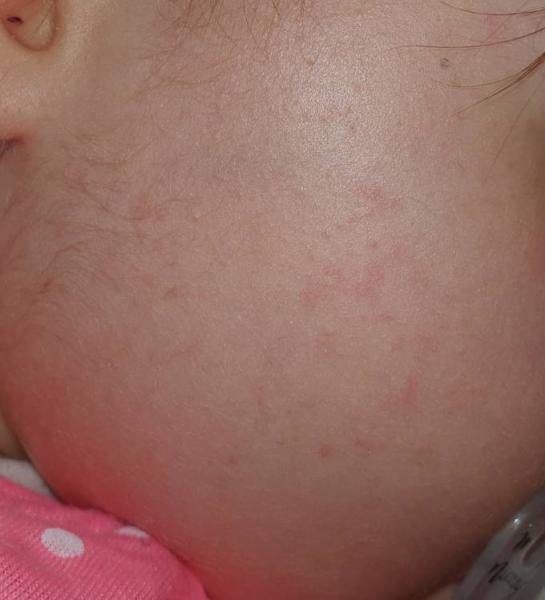 Bild zu Besten Tipps gegen Hitzepickel? - Baby Forum - Allgemeine Themen