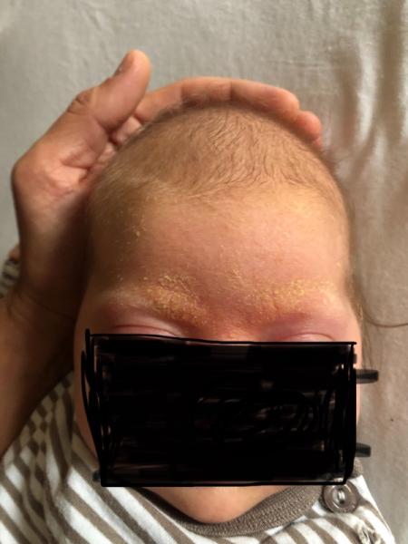 Bild zu Milchschorf oder Kopfgneis - Baby Forum - Allgemeine Themen