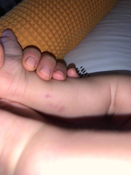 Bild zu Komische Flecken am Bein - Baby Forum - Allgemeine Themen