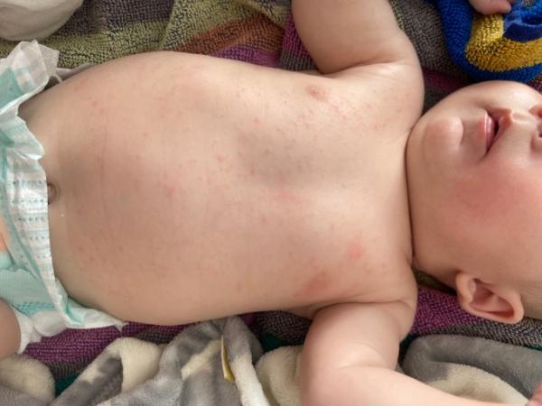 Bild zu Pickel - Baby Forum - Allgemeine Themen