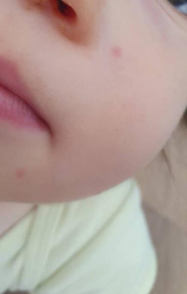 Bild zu Kennt jemand solche Insektenstiche? - Baby Forum - Allgemeine Themen