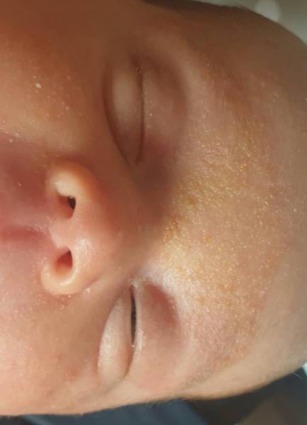 Bild zu Babyakne/2-3 Tage Urlaub - Baby Forum - Allgemeine Themen