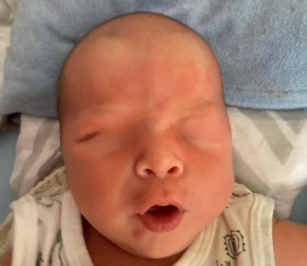 Bild zu Stirn/rote Flecken - Baby Forum - Allgemeine Themen