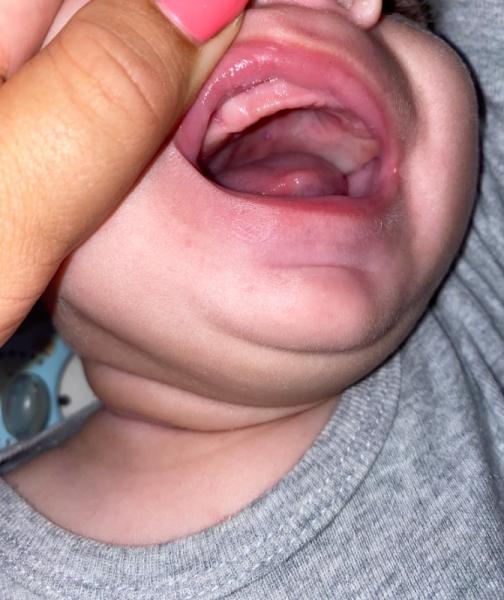 Bild zu Pickel im mund baby - Baby Forum - Allgemeine Themen