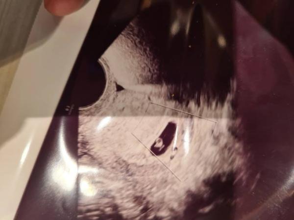 Bild zu Fehlgeburt - Baby Forum - Allgemeine Themen