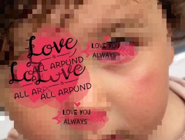 Bild zu Geschwollene augen unter dem auge - Baby Forum - Allgemeine Themen