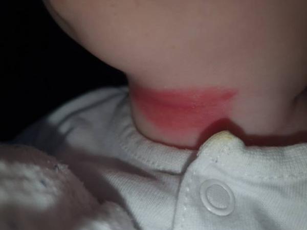 Bild zu Rote Stelle am Hals - Baby Forum - Allgemeine Themen