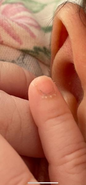 Bild zu Weisse punkte an Finger - Baby Forum - Allgemeine Themen