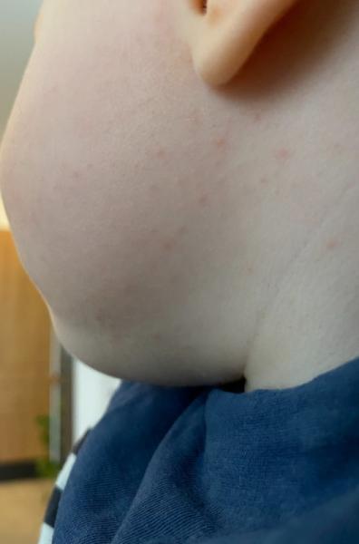 Bild zu Ausschlag - Baby Forum - Allgemeine Themen