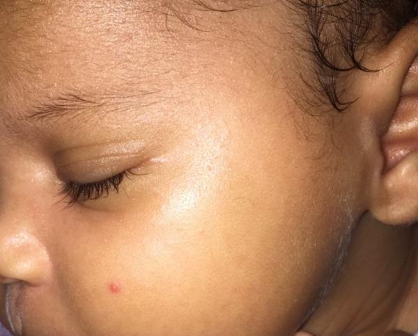 Bild zu Pickel oder was ?! Baby 1 monat alt - Baby Forum - Allgemeine Themen