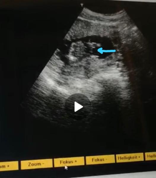 Bild zu Könnt ihr evtl. Das Geschlecht erkennen? - Baby Forum - Allgemeine Themen