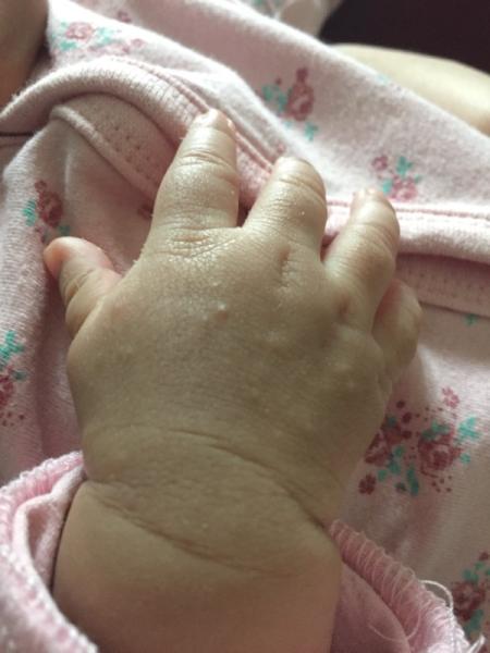 Bild zu Baby ein monat alt pickel hand aussen - Baby Forum - Allgemeine Themen