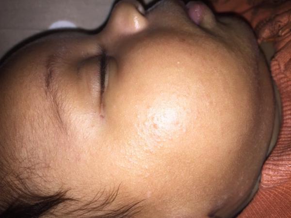 Bild zu Baby 6 wochen alt pickel - Baby Forum - Allgemeine Themen
