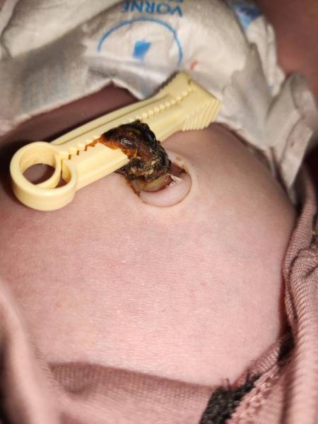 Bild zu Ist der Nabelschnurrest "in Ordnung"? - Baby Forum - Allgemeine Themen