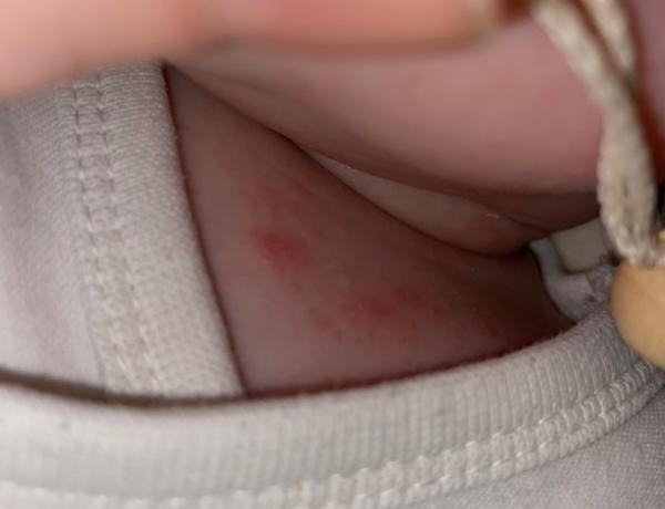 Bild zu Impfreaktion, Neurodermitis, Ekzem, Pilz ??? - Baby Forum - Allgemeine Themen