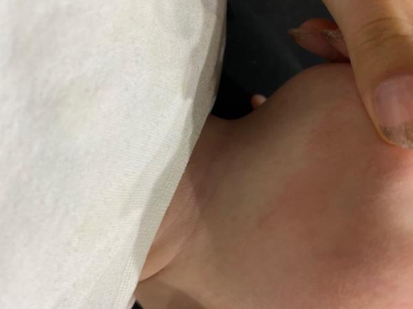 Bild zu Trockene Hautstelle - Baby Forum - Allgemeine Themen