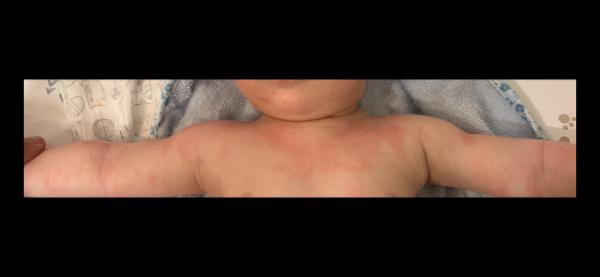 Bild zu Ausschlag Baby 5 Monate - Baby Forum - Allgemeine Themen