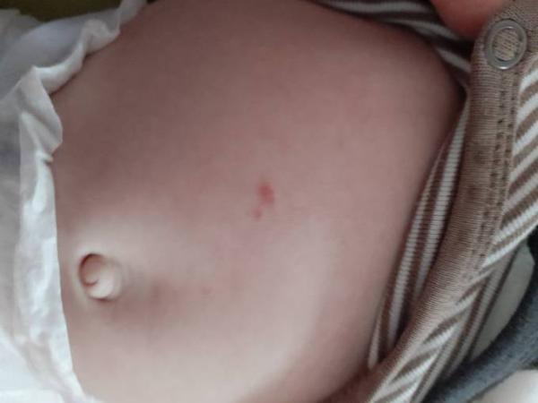 Bild zu 3.5 Monate altes baby 1 erhabener roter Fleck am bauch - Baby Forum - Allgemeine Themen