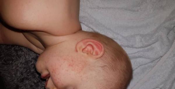 Bild zu Ausschlag Pickel - Baby Forum - Allgemeine Themen