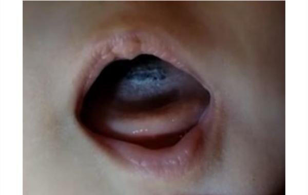 Bild zu Schwarze Zunge ??? Hilfe, Ärzte ratlos - Baby Forum - Allgemeine Themen