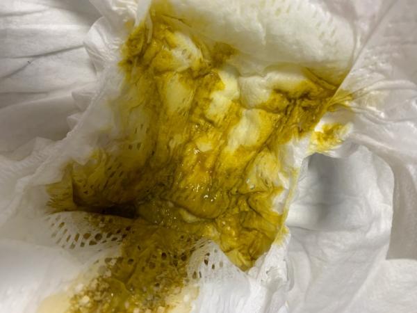 Bild zu Stuhlgang normal? Muss leider nochmal nachfragen - Baby Forum - Allgemeine Themen