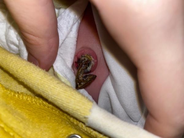 Bild zu Sieht nabel wirklich normal aus - Baby Forum - Allgemeine Themen