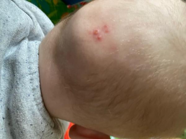 Bild zu Sind das Pickel? Oder was ist das? - Baby Forum - Allgemeine Themen