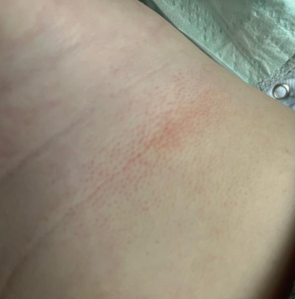 Bild zu Ausschlag ! Bitte um Rat - Baby Forum - Allgemeine Themen