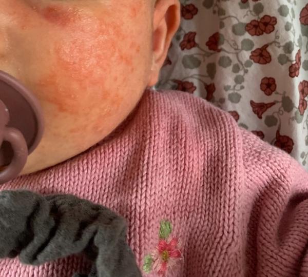 Bild zu Babyakne oder etwas anderes? - Baby Forum - Allgemeine Themen
