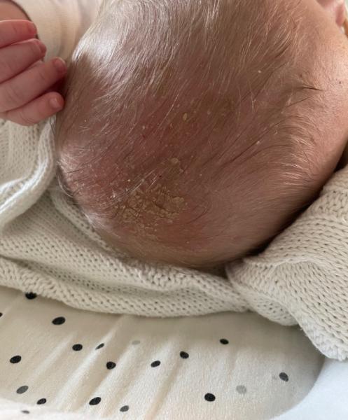 Bild zu Kopfgneis Milchschorf oder Pilzbefall - Baby Forum - Allgemeine Themen