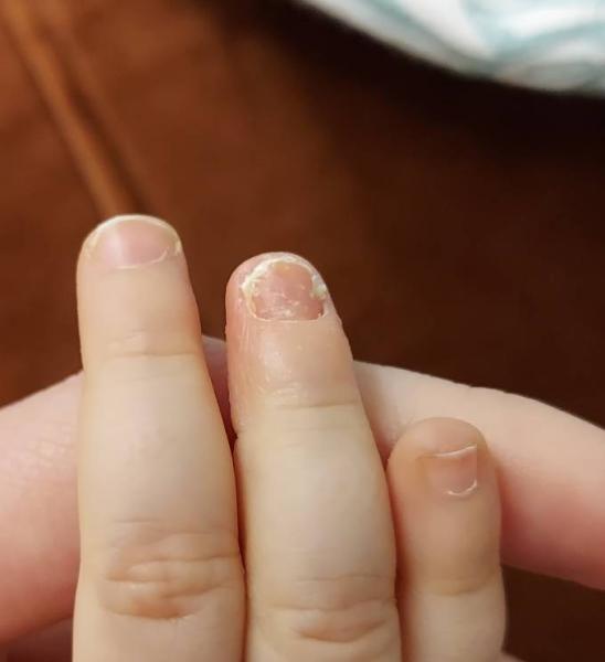 Bild zu Komischer Fingernagel - Baby Forum - Allgemeine Themen