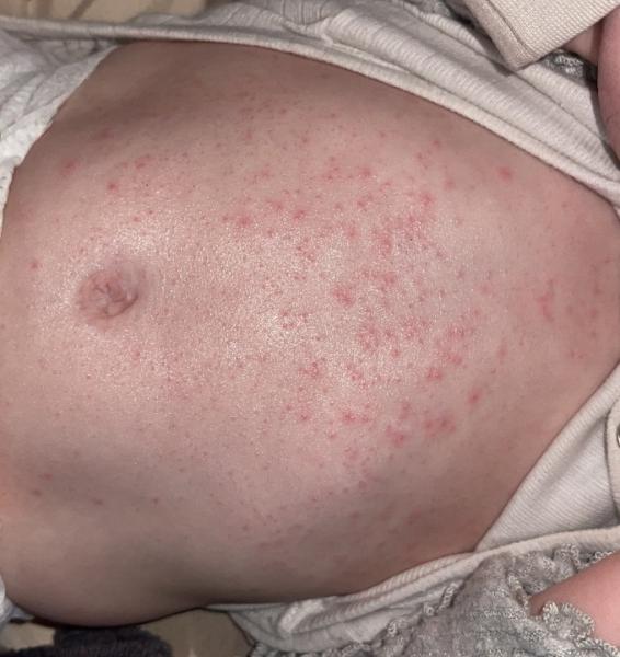 Bild zu Ausschlag - Baby Forum - Allgemeine Themen