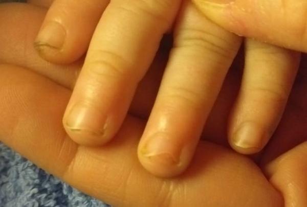 Bild zu Nur der halbe Nagel wächst - Baby Forum - Allgemeine Themen