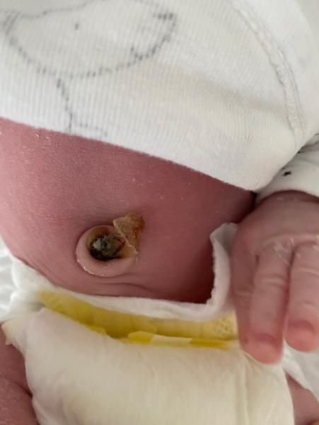 Bild zu Bauchnabelrand Bräunlich - Baby Forum - Allgemeine Themen