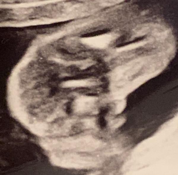 Bild zu Geschlecht erkennen - Baby Forum - Allgemeine Themen