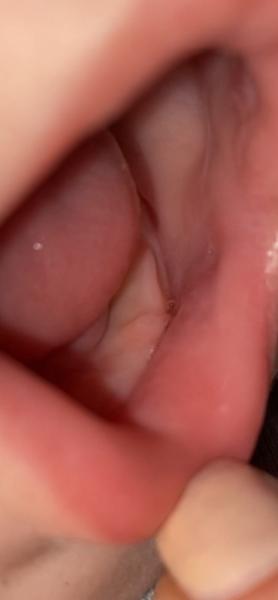 Bild zu Zahn oder Afte oder was anderes - Baby Forum - Allgemeine Themen