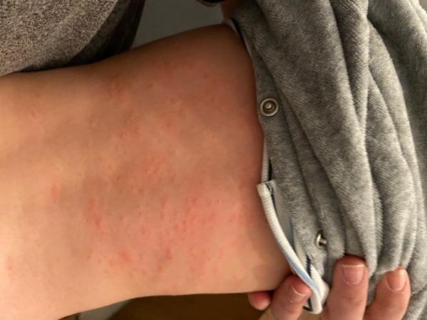 Bild zu Ausschlag am Rücken…Hitzepickel? - Baby Forum - Allgemeine Themen