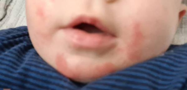 Bild zu Sabberausschlag - Baby Forum - Allgemeine Themen