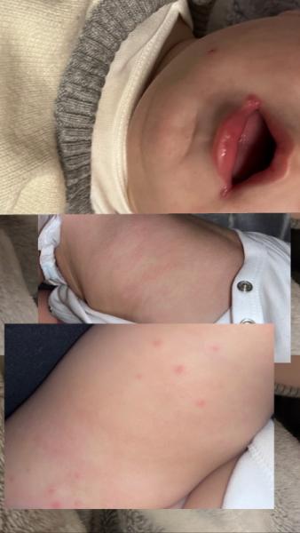 Bild zu Pickel/flecken am körper - Baby Forum - Allgemeine Themen