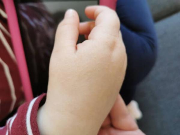 Bild zu "Pickelchen" auf Handrücken - Baby Forum - Allgemeine Themen