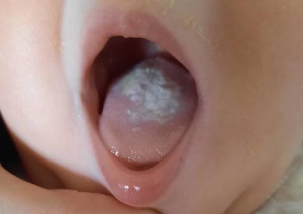 Bild zu Belag auf der Zunge - Baby Forum - Allgemeine Themen