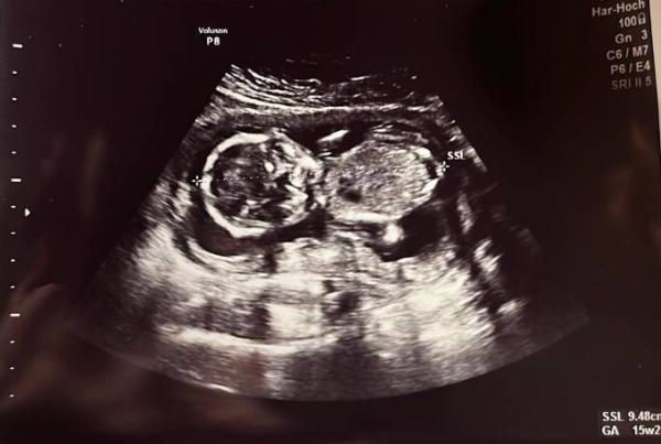 Bild zu SSW 16 Baby Geschlecht - Baby Forum - Allgemeine Themen